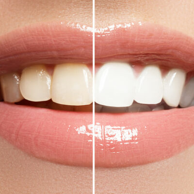 5 reasons at-home teeth whitening isn’t ideal always
